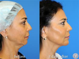    - 30-Minute Non-Surgical Facelift,    , 36950757  